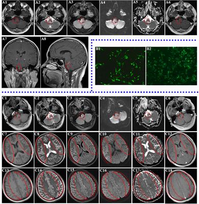 Case Report: Anti-NMDAR Encephalitis With Anti-MOG CNS Demyelination After Recurrent CNS Demyelination